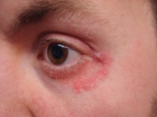 Покраснение кожи вокруг глаз: причины и лечение