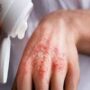 Сухая экзема на руках, чем лечить?