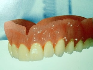 Что такое съемный пластиночный зубной протез