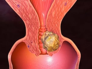 Каковы причины развития рака шейки матки, лечение