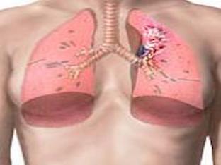 Рак лёгких – факторы риска, развитие и симптомы, диагностика и лечение