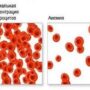 Анемия: профилактика, симптомы и лечение