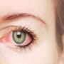 Почему возникает покраснение глаз и как его лечить?
