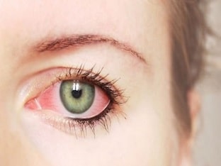 Почему возникает покраснение глаз и как его лечить