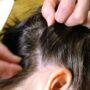 Вши в волосах — что делать, как избавиться?