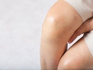 Сосудистые звёздочки на ногах: причины и лечение