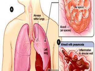Что делать при тихой пневмонии