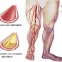 Как лечить облитерирующий атеросклероз?