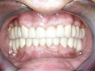 Какие мостовидные протезы существуют и как устанавливается мост на зубы