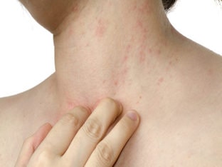 Причины возникновения аллергии на коже