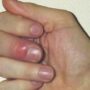 Чем лечить панариций околоногтевой на руках?
