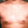 Чем вызваны высыпания на груди?