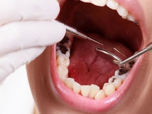 Кариес между зубами: как его лечить
