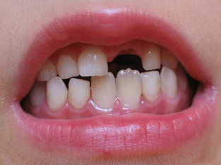 Молочные зубы: когда выпадают, причины отклонений, что делать