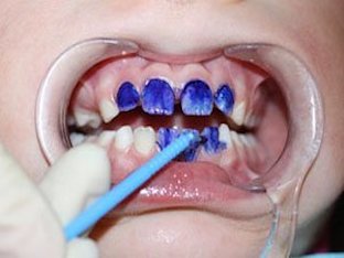 Нужно ли ребенку серебрение молочных зубов