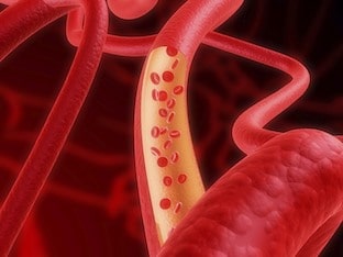 Симптомы и лечение атеросклероза сосудов сердца