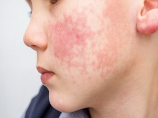 Аллергия на холод: как проявляется и чем лечить
