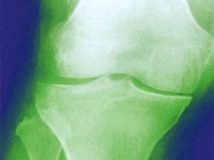 Артроз коленного сустава, его симптомы и лечение