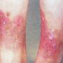 Микробная экзема — лечение, симптомы, причины
