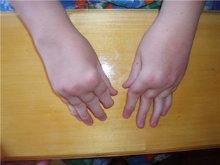 Симптомы ювенильного ревматоидного артрита у ребенка