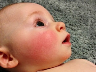 У ребенка краснеют щеки: почему и как лечиться