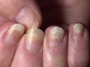 Чем лечить псориаз ногтей
