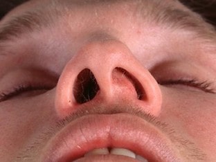 Что делать при искривлении перегородки носа