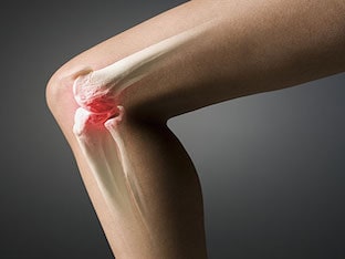Что это такое  –  артроз коленного сустава(гонартроз)