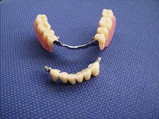 Что такое условно-съемные протезы для зубов