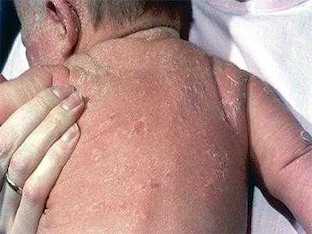 Эксфолиативный дерматит у ребенка, что делать
