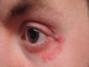 Как проявляется аллергия на глазах и как ее лечить