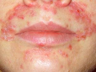 Как проявляется дерматит на лице и какими способами устраняется