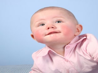 Как вылечить диатез у ребенка на щеках