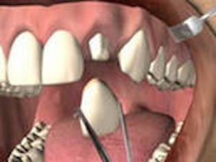 Какие бывают протезы для зубов