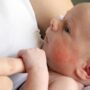 Каковы причины атопического дерматита у грудничков?