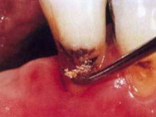 Кариес корня зуба: лечить или удалять