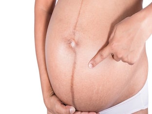О чем расскажет темная полоска на животе у беременных