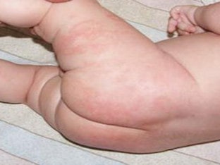 Пеленочный дерматит у детей