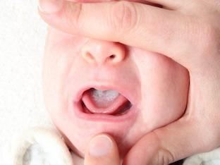 Почему появился белый налет во рту у грудничка: как лечить