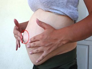 Пупочная грыжа у беременных: опасна ли она