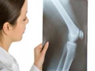 Симптомы и лечение при некрозе (омертвления)суставов, костей
