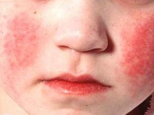 Симптомы краснухи у деток до 1 года