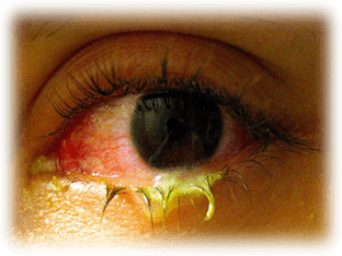 Вирусный конъюнктивит глаз: причины, симптомы
