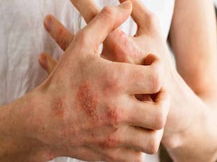 Что представляет собой атипичный дерматит, чем лечить
