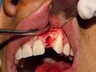 Альвеолит после удаления зуба: причины, симптомы