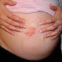 Каковы причины атопического дерматита при беременности?