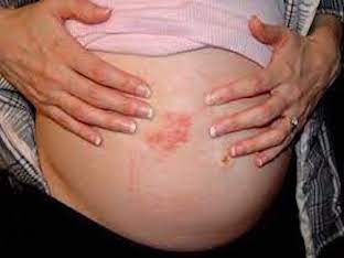 Каковы причины атопического дерматита при беременности