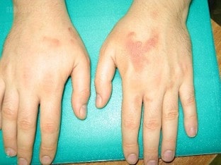 Чем лечить аллергический дерматит на руках