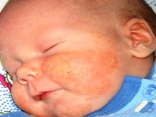 Что чаще всего вызывает атопический дерматит у детей