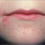 Что делать, если пероральный дерматит на лице?